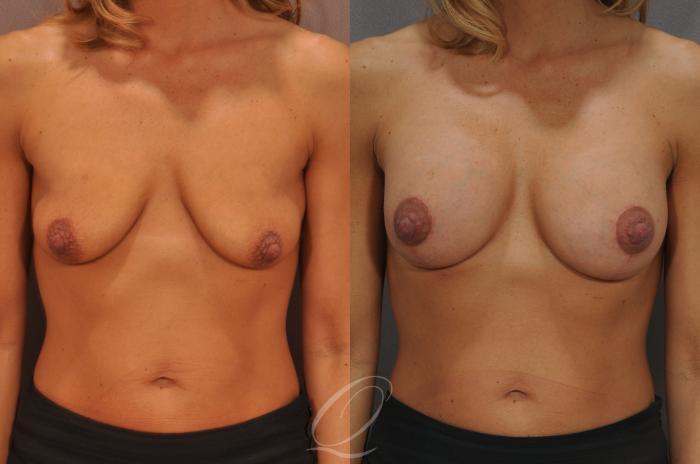 Breast Augmentation with Lift Case 104 Before & After View #1 | Serving Rochester, Syracuse & Buffalo, NY | Quatela Center for Plastic Surgery