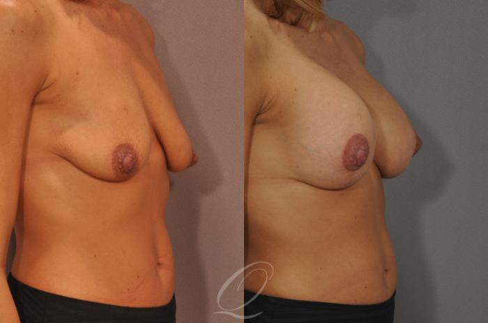Breast Augmentation with Lift Case 104 Before & After View #2 | Serving Rochester, Syracuse & Buffalo, NY | Quatela Center for Plastic Surgery
