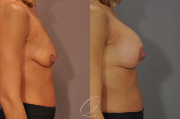 Breast Augmentation with Lift Case 104 Before & After View #3 | Serving Rochester, Syracuse & Buffalo, NY | Quatela Center for Plastic Surgery