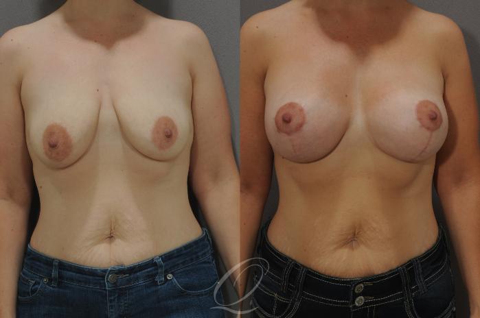 Breast Augmentation with Lift Case 106 Before & After View #1 | Serving Rochester, Syracuse & Buffalo, NY | Quatela Center for Plastic Surgery
