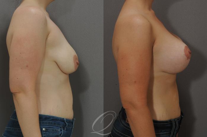 Breast Augmentation with Lift Case 106 Before & After View #3 | Serving Rochester, Syracuse & Buffalo, NY | Quatela Center for Plastic Surgery