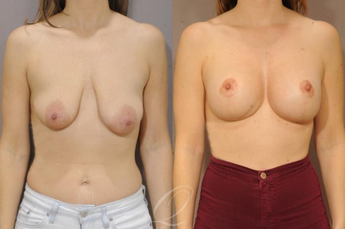 Breast Augmentation with Lift Case 1109 Before & After View #1 | Serving Rochester, Syracuse & Buffalo, NY | Quatela Center for Plastic Surgery