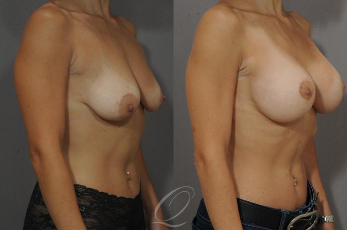 Breast Augmentation with Lift Case 114 Before & After View #2 | Serving Rochester, Syracuse & Buffalo, NY | Quatela Center for Plastic Surgery
