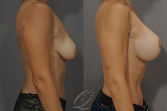 Breast Augmentation with Lift Case 114 Before & After View #3 | Serving Rochester, Syracuse & Buffalo, NY | Quatela Center for Plastic Surgery