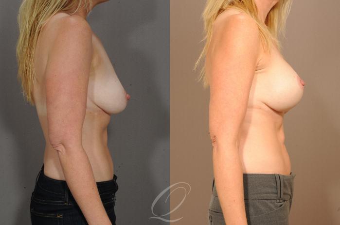 Breast Augmentation with Lift Case 1148 Before & After View #3 | Serving Rochester, Syracuse & Buffalo, NY | Quatela Center for Plastic Surgery