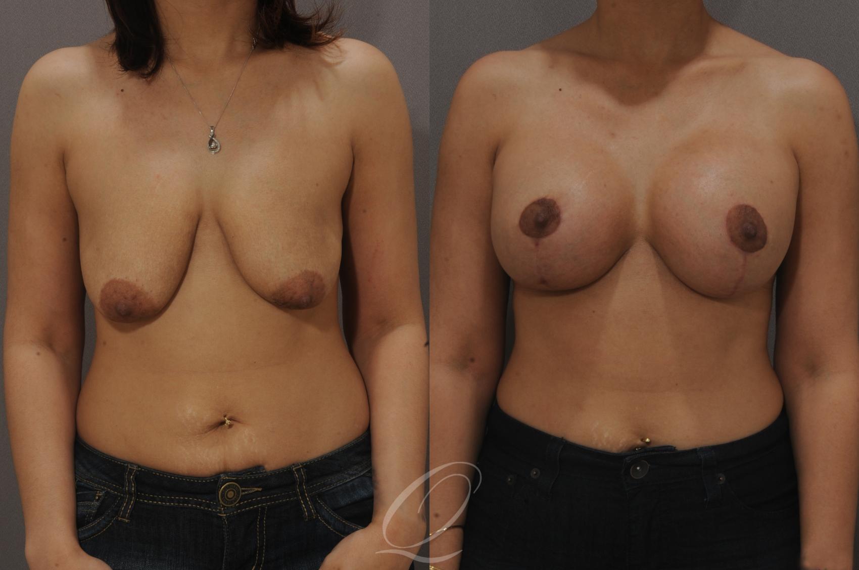 Breast Augmentation with Lift Case 115 Before & After View #1 | Serving Rochester, Syracuse & Buffalo, NY | Quatela Center for Plastic Surgery