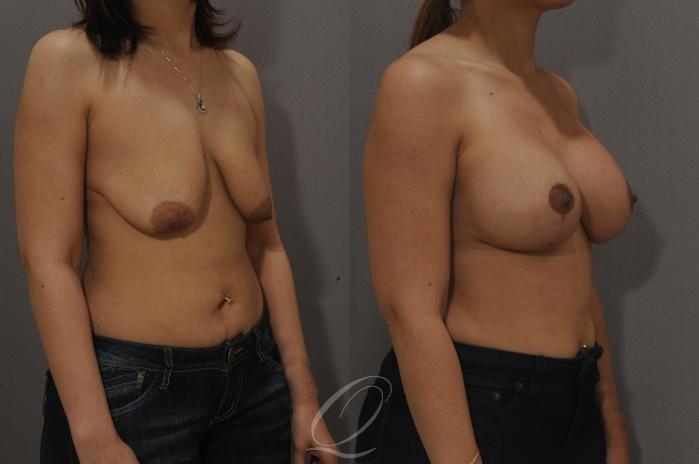 Breast Augmentation with Lift Case 115 Before & After View #2 | Serving Rochester, Syracuse & Buffalo, NY | Quatela Center for Plastic Surgery