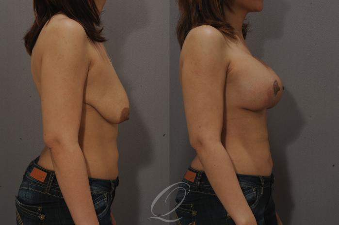Breast Augmentation with Lift Case 115 Before & After View #3 | Serving Rochester, Syracuse & Buffalo, NY | Quatela Center for Plastic Surgery