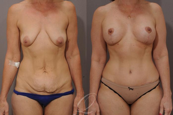 Breast Augmentation with Lift Case 118 Before & After View #1 | Serving Rochester, Syracuse & Buffalo, NY | Quatela Center for Plastic Surgery