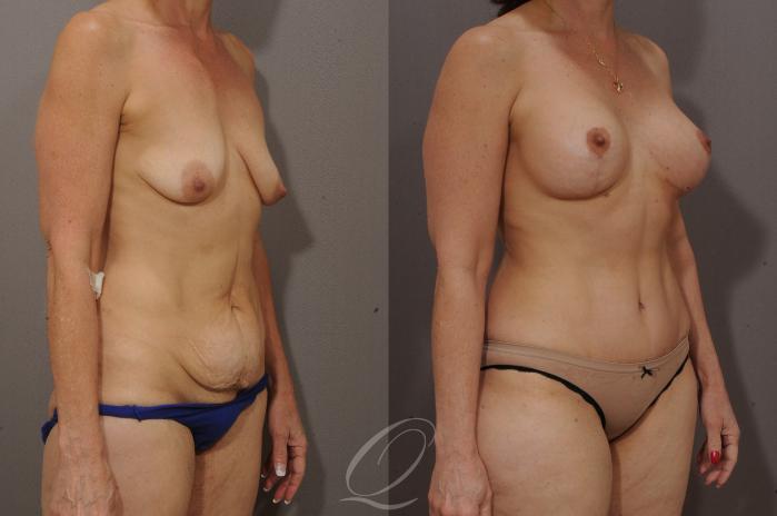 Breast Augmentation with Lift Case 118 Before & After View #2 | Serving Rochester, Syracuse & Buffalo, NY | Quatela Center for Plastic Surgery