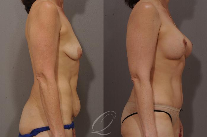 Breast Augmentation with Lift Case 118 Before & After View #3 | Serving Rochester, Syracuse & Buffalo, NY | Quatela Center for Plastic Surgery