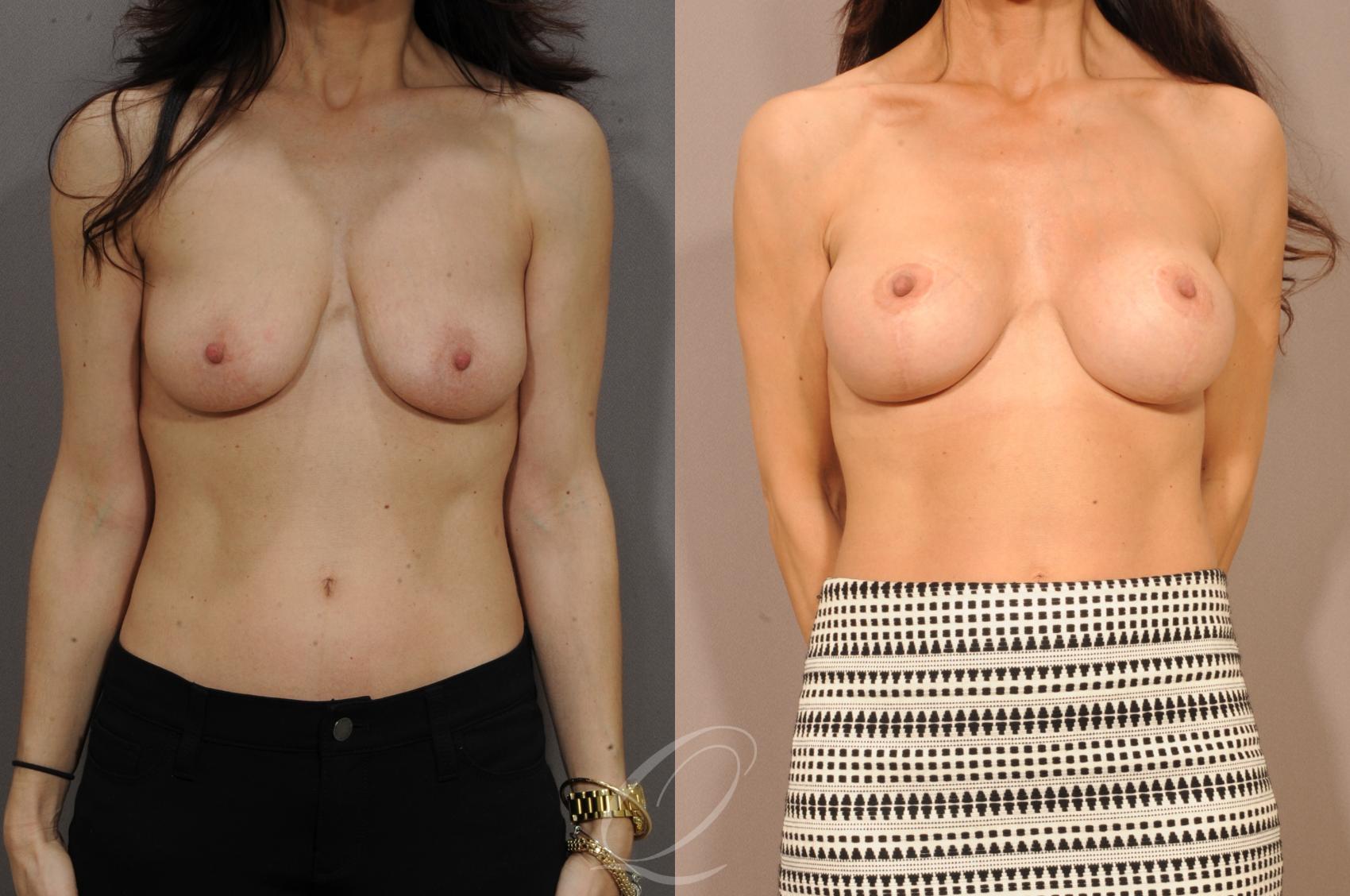 Breast Augmentation with Lift Case 120 Before & After View #1 | Serving Rochester, Syracuse & Buffalo, NY | Quatela Center for Plastic Surgery