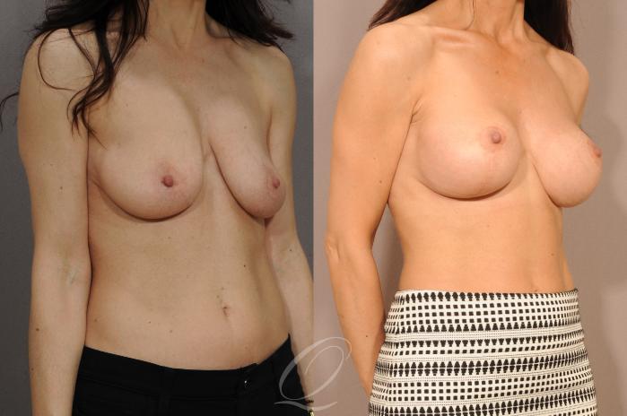 Breast Augmentation with Lift Case 120 Before & After View #2 | Serving Rochester, Syracuse & Buffalo, NY | Quatela Center for Plastic Surgery