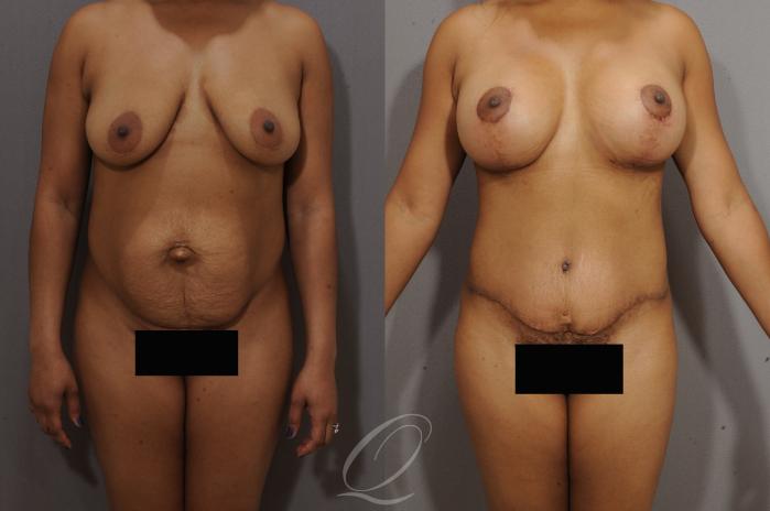 Breast Augmentation with Lift Case 121 Before & After View #1 | Serving Rochester, Syracuse & Buffalo, NY | Quatela Center for Plastic Surgery