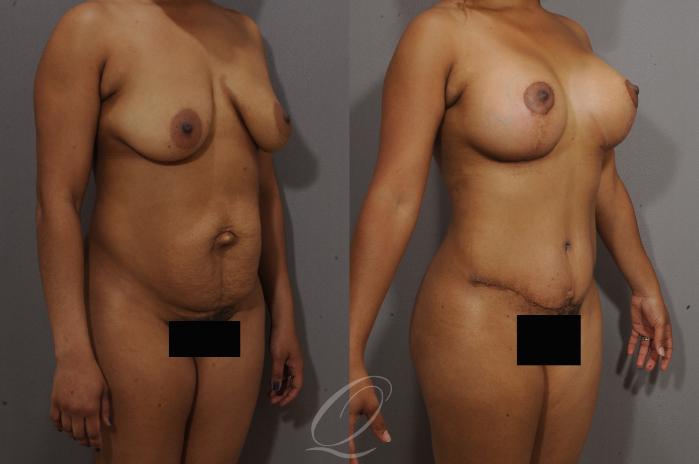 Breast Augmentation with Lift Case 121 Before & After View #2 | Serving Rochester, Syracuse & Buffalo, NY | Quatela Center for Plastic Surgery