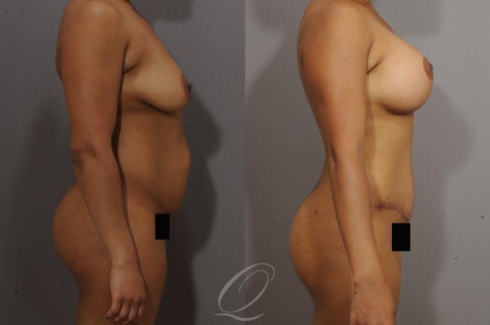 Breast Augmentation with Lift Case 121 Before & After View #3 | Serving Rochester, Syracuse & Buffalo, NY | Quatela Center for Plastic Surgery