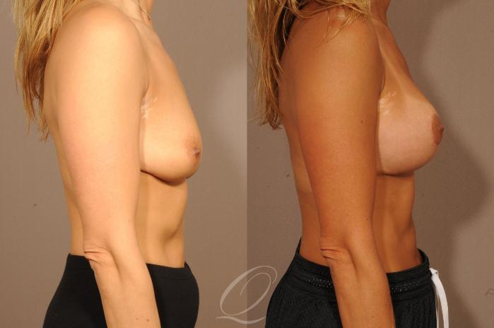 Breast Augmentation with Lift Case 1232 Before & After View #3 | Serving Rochester, Syracuse & Buffalo, NY | Quatela Center for Plastic Surgery