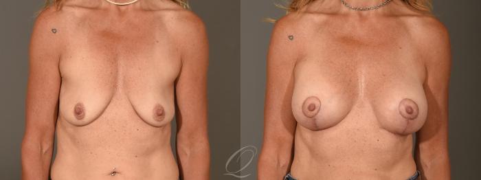 Breast Augmentation with Lift Case 1388 Before & After Front | Serving Rochester, Syracuse & Buffalo, NY | Quatela Center for Plastic Surgery