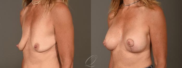 Breast Augmentation with Lift Case 1388 Before & After Left Oblique | Serving Rochester, Syracuse & Buffalo, NY | Quatela Center for Plastic Surgery