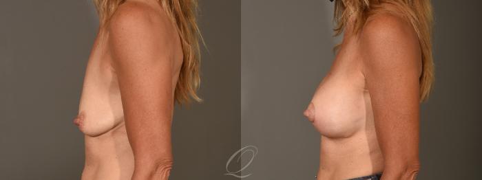 Breast Augmentation with Lift Case 1388 Before & After Left Side | Serving Rochester, Syracuse & Buffalo, NY | Quatela Center for Plastic Surgery
