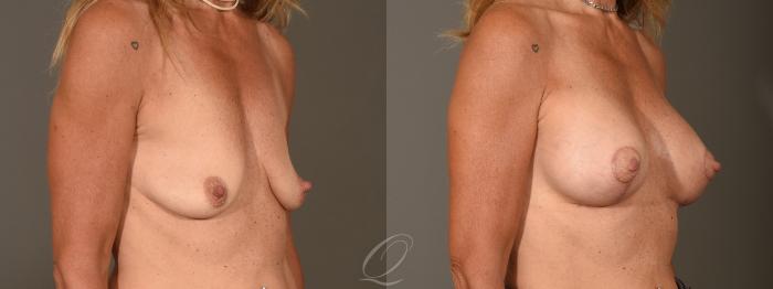 Breast Augmentation with Lift Case 1388 Before & After Right Oblique | Serving Rochester, Syracuse & Buffalo, NY | Quatela Center for Plastic Surgery