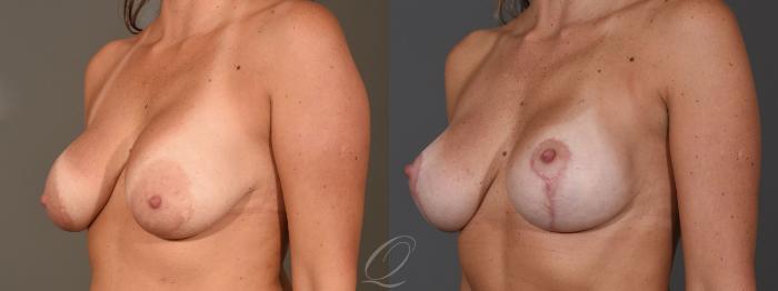Breast Augmentation with Lift Case 1398 Before & After Left Oblique | Serving Rochester, Syracuse & Buffalo, NY | Quatela Center for Plastic Surgery