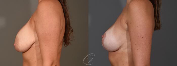 Breast Augmentation with Lift Case 1398 Before & After Left Side | Serving Rochester, Syracuse & Buffalo, NY | Quatela Center for Plastic Surgery