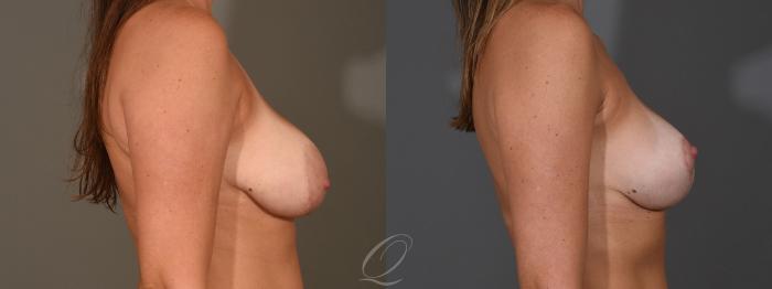 Breast Augmentation with Lift Case 1398 Before & After Right Side | Serving Rochester, Syracuse & Buffalo, NY | Quatela Center for Plastic Surgery