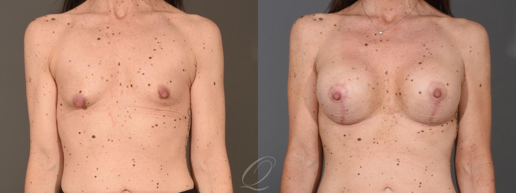 Breast Augmentation with Lift Case 1399 Before & After Front | Serving Rochester, Syracuse & Buffalo, NY | Quatela Center for Plastic Surgery