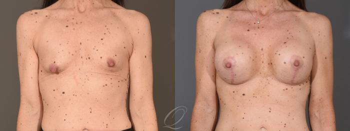 Breast Augmentation with Lift Case 1399 Before & After Front | Serving Rochester, Syracuse & Buffalo, NY | Quatela Center for Plastic Surgery