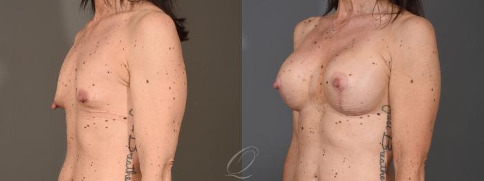 Breast Augmentation with Lift Case 1399 Before & After Left Oblique | Serving Rochester, Syracuse & Buffalo, NY | Quatela Center for Plastic Surgery