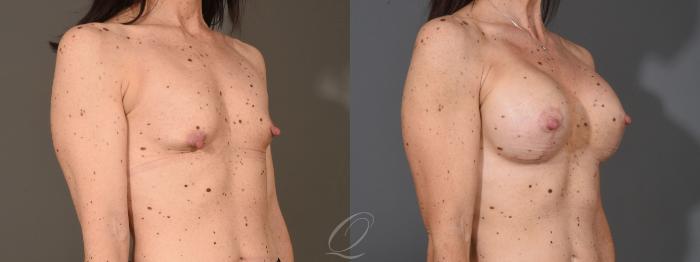 Breast Augmentation with Lift Case 1399 Before & After Right Oblique | Serving Rochester, Syracuse & Buffalo, NY | Quatela Center for Plastic Surgery