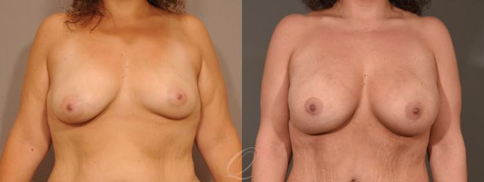 Breast Augmentation with Lift Case 1473 Before & After Front | Serving Rochester, Syracuse & Buffalo, NY | Quatela Center for Plastic Surgery