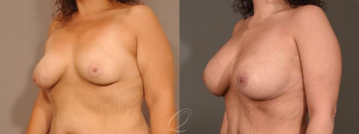 Breast Augmentation with Lift Case 1473 Before & After Left Oblique | Serving Rochester, Syracuse & Buffalo, NY | Quatela Center for Plastic Surgery