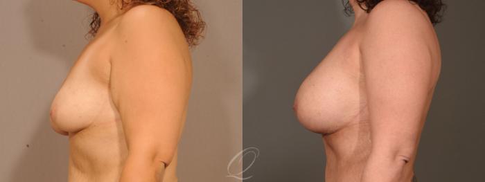 Breast Augmentation with Lift Case 1473 Before & After Left Side | Serving Rochester, Syracuse & Buffalo, NY | Quatela Center for Plastic Surgery