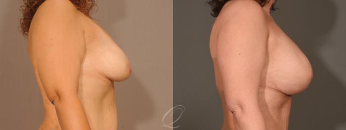 Breast Augmentation with Lift Case 1473 Before & After Right Side | Serving Rochester, Syracuse & Buffalo, NY | Quatela Center for Plastic Surgery