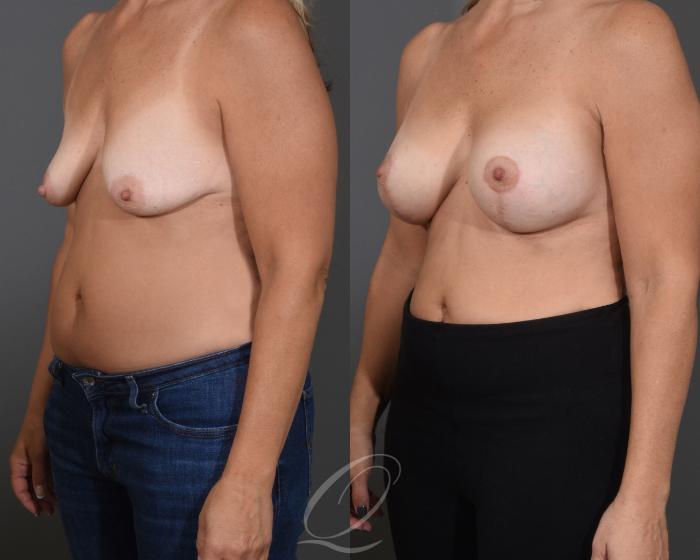 Breast Augmentation with Lift Case 1474 Before & After Left Oblique | Serving Rochester, Syracuse & Buffalo, NY | Quatela Center for Plastic Surgery