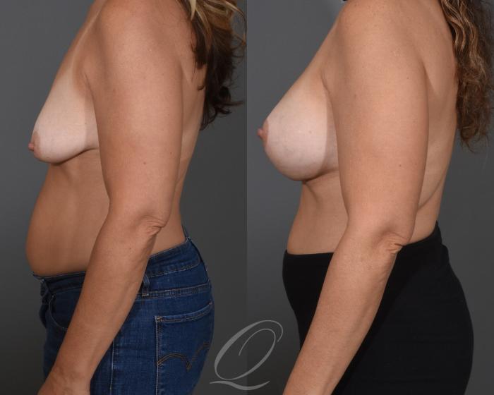 Breast Augmentation with Lift Case 1474 Before & After Left Side | Serving Rochester, Syracuse & Buffalo, NY | Quatela Center for Plastic Surgery