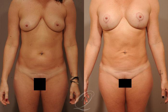 Breast Augmentation with Lift Case 1528 Before & After View #1 | Serving Rochester, Syracuse & Buffalo, NY | Quatela Center for Plastic Surgery
