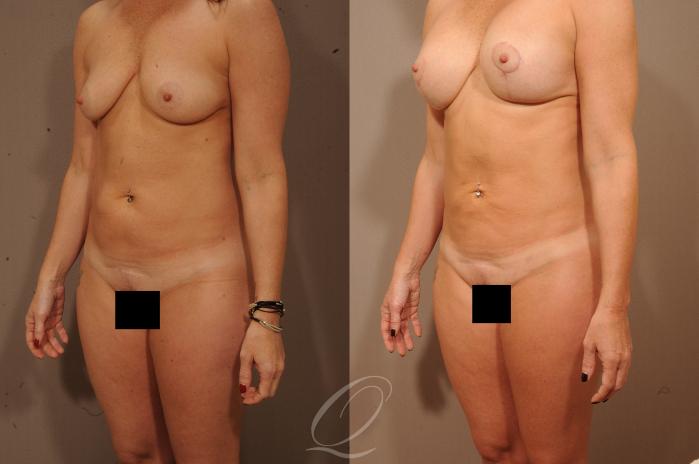 Breast Augmentation with Lift Case 1528 Before & After View #2 | Serving Rochester, Syracuse & Buffalo, NY | Quatela Center for Plastic Surgery