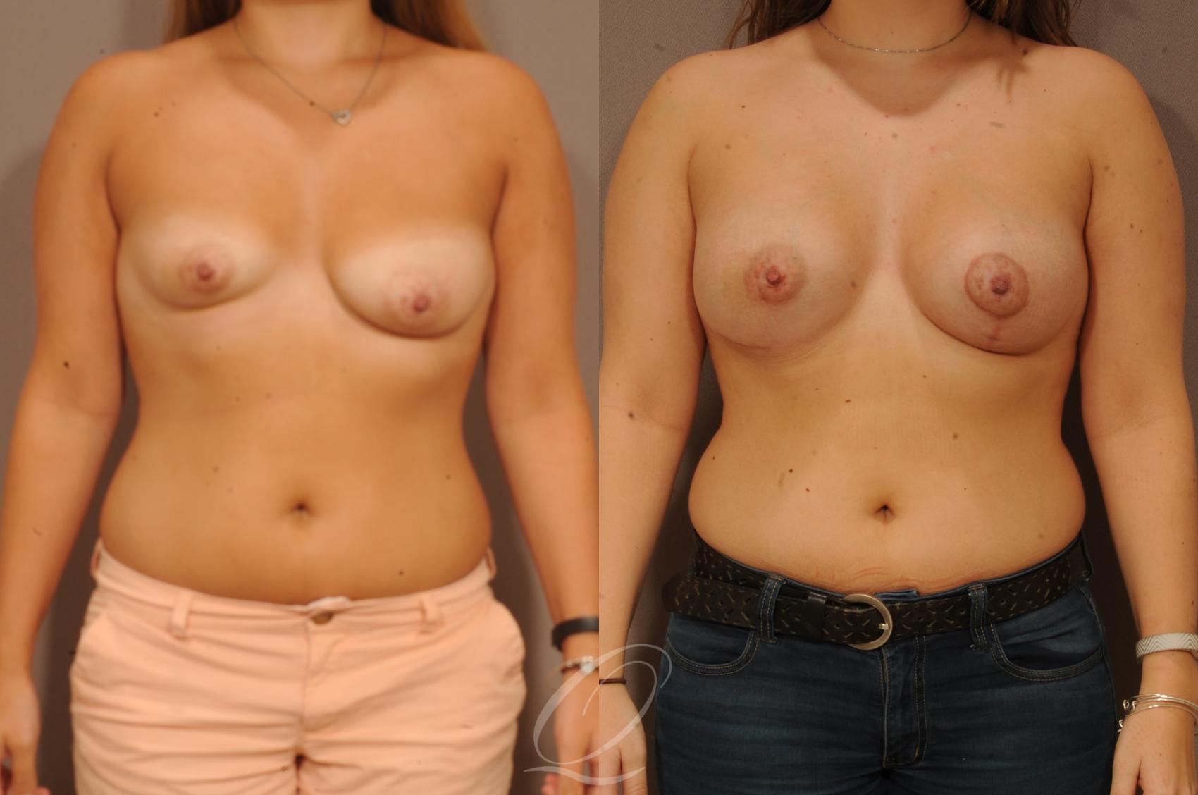 Breast Augmentation with Lift Case 266 Before & After View #1 | Serving Rochester, Syracuse & Buffalo, NY | Quatela Center for Plastic Surgery