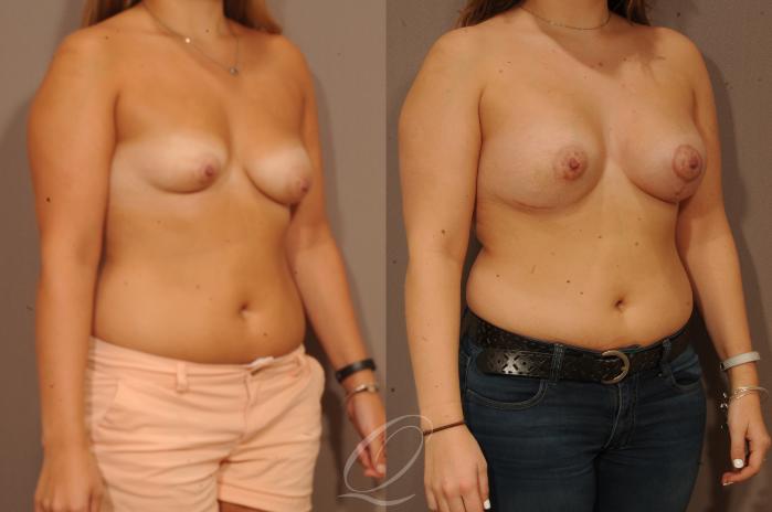 Breast Augmentation with Lift Case 266 Before & After View #2 | Serving Rochester, Syracuse & Buffalo, NY | Quatela Center for Plastic Surgery