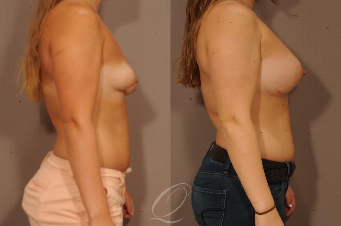 Breast Augmentation with Lift Case 266 Before & After View #3 | Serving Rochester, Syracuse & Buffalo, NY | Quatela Center for Plastic Surgery