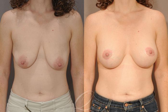 Breast Augmentation with Lift Case 281 Before & After View #1 | Serving Rochester, Syracuse & Buffalo, NY | Quatela Center for Plastic Surgery