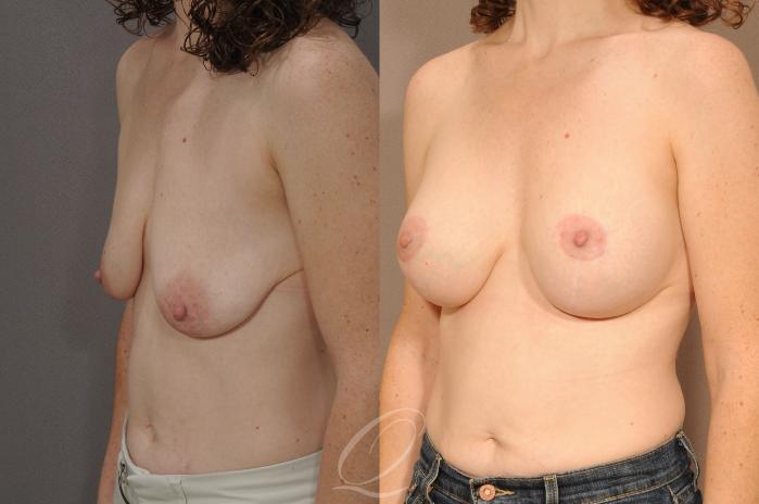 Breast Augmentation with Lift Case 281 Before & After View #2 | Serving Rochester, Syracuse & Buffalo, NY | Quatela Center for Plastic Surgery