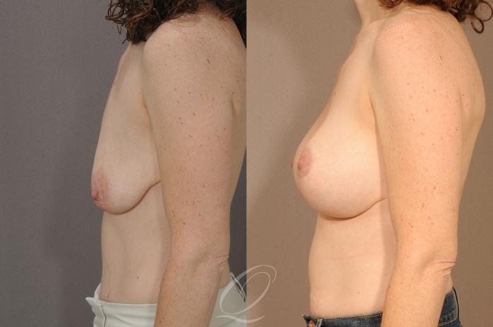 Breast Augmentation with Lift Case 281 Before & After View #3 | Serving Rochester, Syracuse & Buffalo, NY | Quatela Center for Plastic Surgery