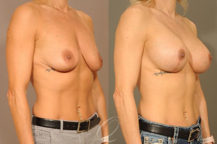 Breast Augmentation with Lift Case 282 Before & After View #2 | Serving Rochester, Syracuse & Buffalo, NY | Quatela Center for Plastic Surgery