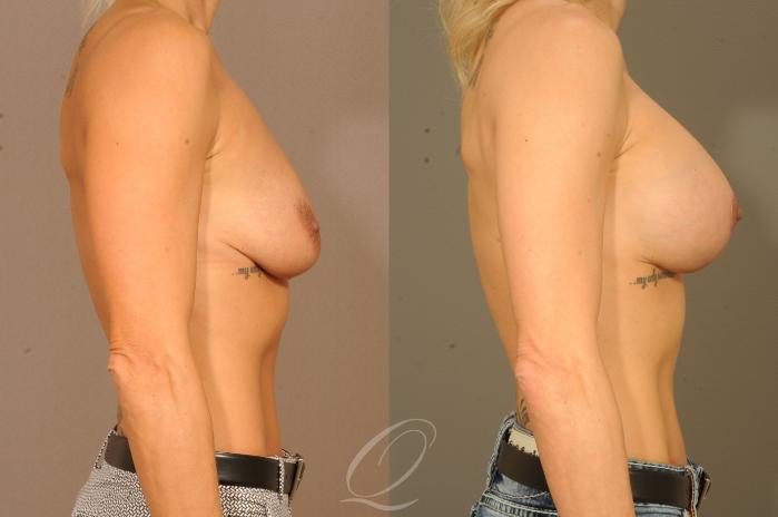 Breast Augmentation with Lift Case 282 Before & After View #3 | Serving Rochester, Syracuse & Buffalo, NY | Quatela Center for Plastic Surgery