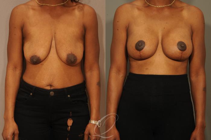 Breast Augmentation with Lift Case 301 Before & After View #1 | Serving Rochester, Syracuse & Buffalo, NY | Quatela Center for Plastic Surgery