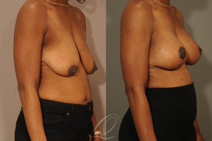 Breast Augmentation with Lift Case 301 Before & After View #2 | Serving Rochester, Syracuse & Buffalo, NY | Quatela Center for Plastic Surgery